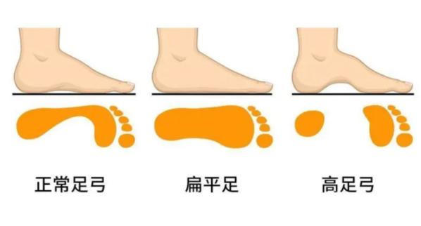 “扁平足”是疾病嗎？是否需要醫(yī)學(xué)干預(yù)？