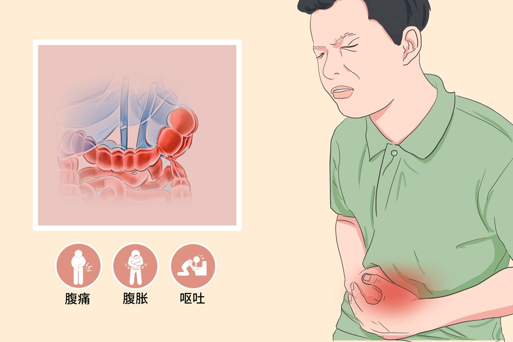 贊！不用開刀，一根導(dǎo)管打通腸梗阻！