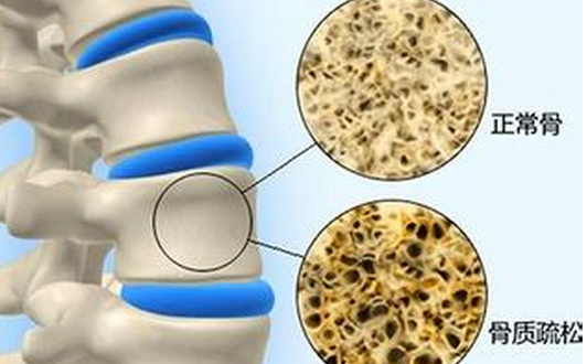 骨質(zhì)疏松，不僅補(bǔ)鈣這么簡(jiǎn)單！