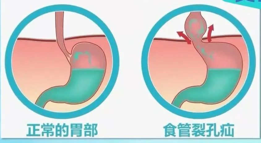 食管裂孔疝——會串門的“胃”